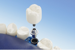 Все про имплантацию и протезирование зубов