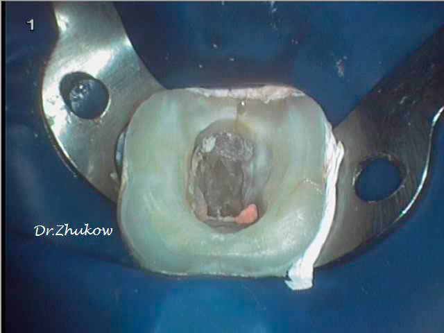 Замена керамической вкладки Зуб после удаления стасой вкладки и вторичного кариеса