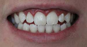 Отбеливание  зубов: случай №5
