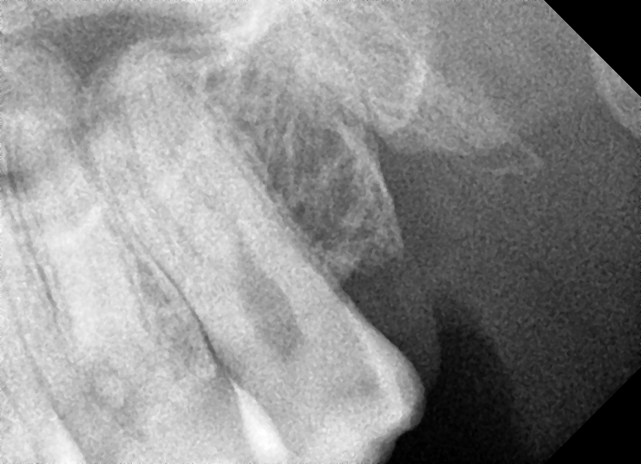 Удаление зуба мудрости Рентгеновский снимок до удаления