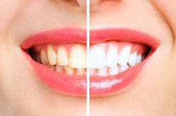 Что происходит во время отбеливания зубов, и вредно ли это?