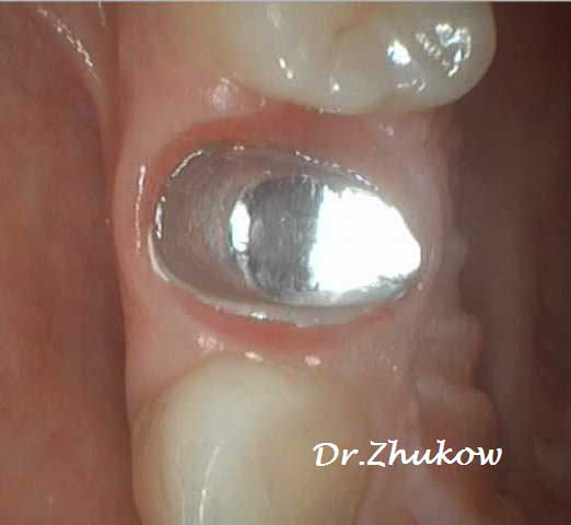 Извлечение инородного тела из каналов с последующим лечением и протезированием Зуб подготовлен для фиксации коронки