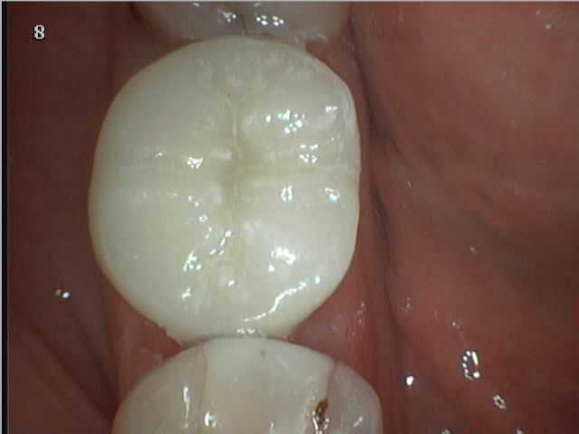 Восстановление зуба керамической вкладкой: случай №1 После восстановления зуба керамической вкладкой