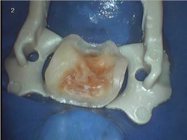 Востановление зуба керамической вкладкой: случай №2 До восстановления зуба
