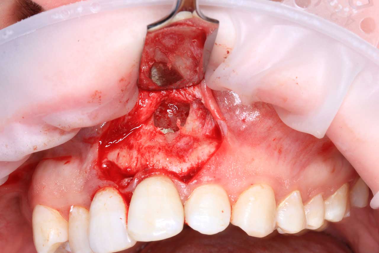 Цистэктомия и резекция верхушки корня 21 зуба Цистэктомия