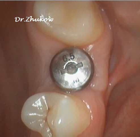 Имплантация  Закрытый имплант зуба.