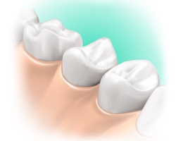 Зубы мудрости: лечить или удалять?
