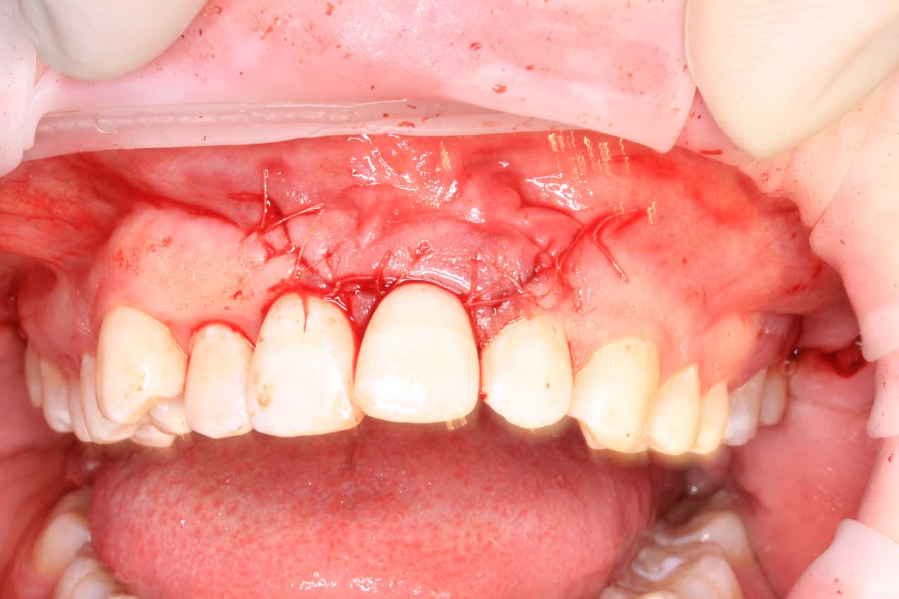 Цистэктомия и резекция верхушки корня 21 зуба Наложение швов