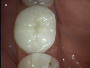Восстановление зуба керамической вкладкой: случай №1