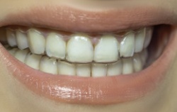 Белые пятна на зубах:  причины и профилактика