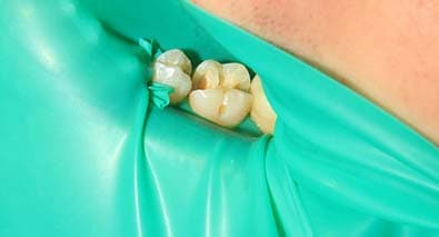 Лечение кариеса: случай №7 Перед началом лечения кариеса зубов