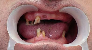 Съемное протезирование: случай №2 До установки съемного протеза зубов