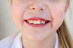  Скученность зубов – стадии, выявление, лечение патологии