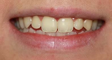 Отбеливание  зубов: случай №5 До отбеливания зубов