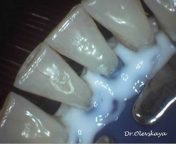 Шинирование зубов Первый этап  шинирования - изоляция слизистой оболочки