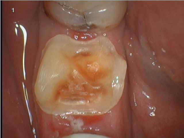 Восстановление зуба керамической вкладкой: случай №1 До начала восстановления зуба керамической вкладкой