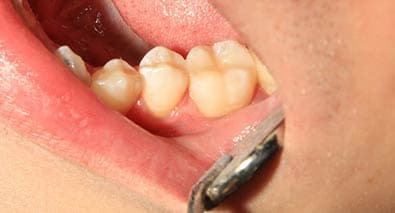 Лечение кариеса: случай №7 После лечения кариеса на зубах