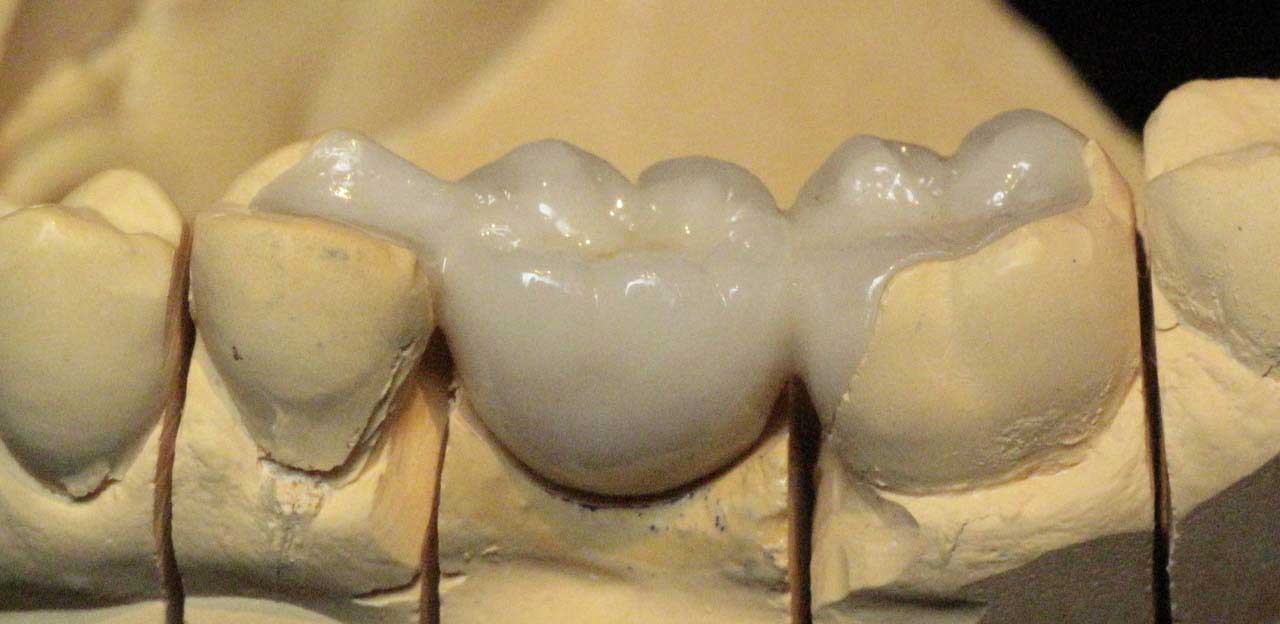 Адгезивное протезирование без обточки зуба - фото