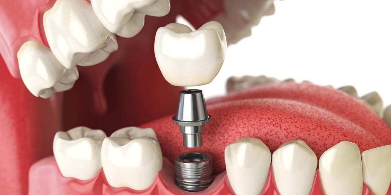 Инвазивное протезирование зубов имплантом