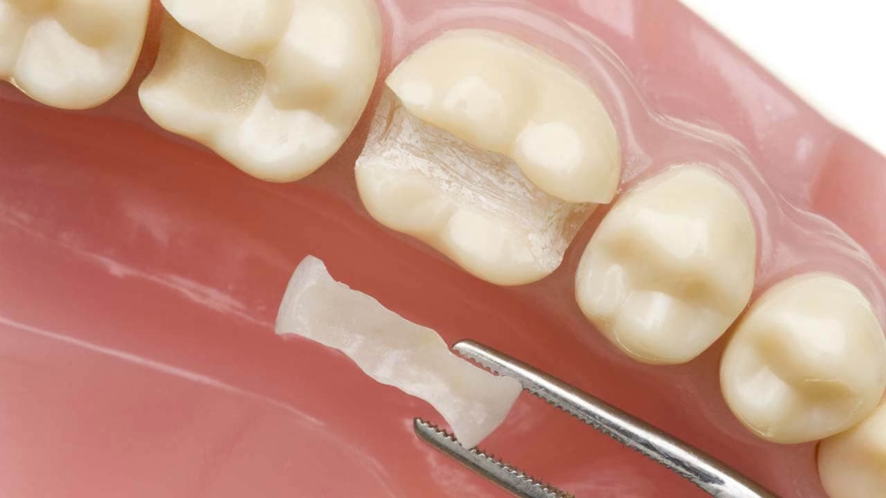 Керамическая вкладка на зубы
