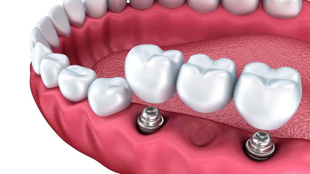 Мостовидное протезирование зубов без обтачивания с опорой на импланты