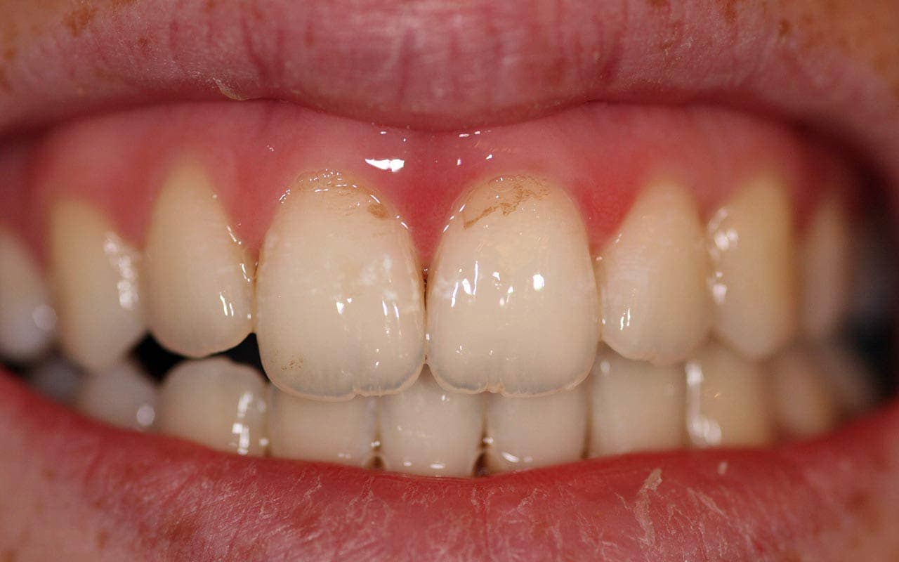 Причины возникновения кариеса передних зубов