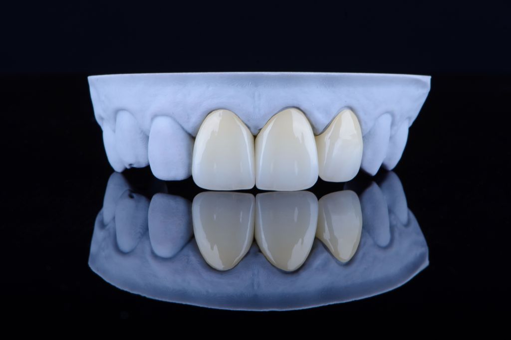 highquality-naturally-dental-single-crowns-made-zirconium-fixation-frontal-teeth.jpg
