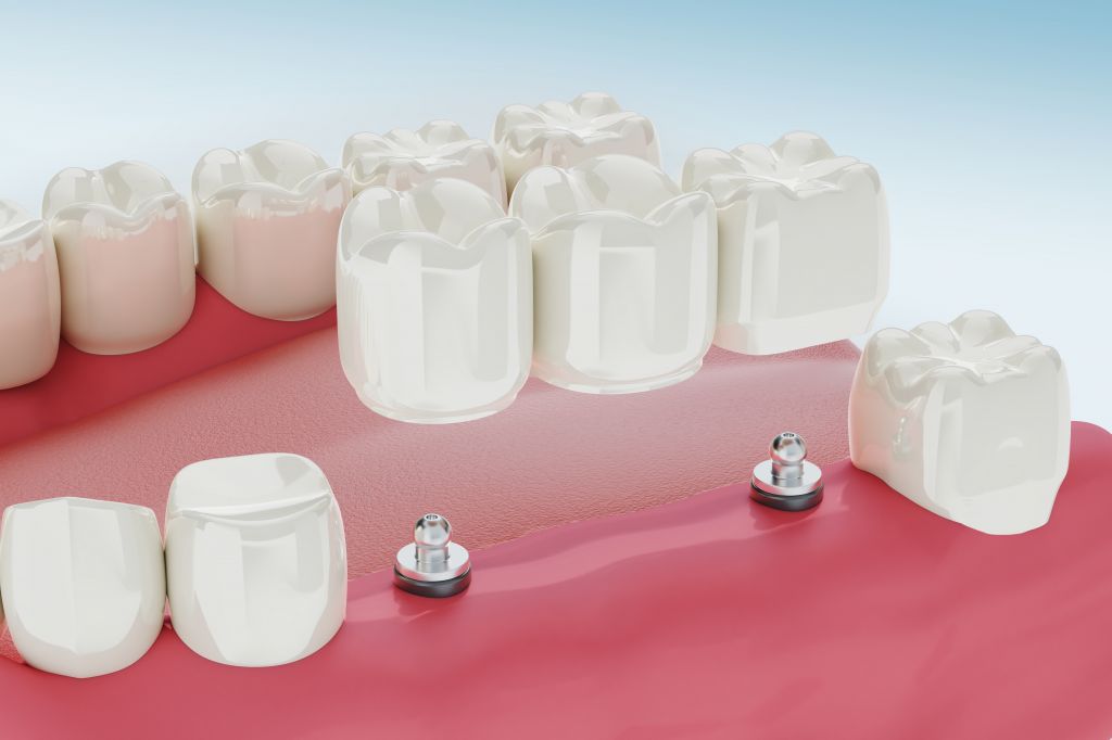 dental-implants-treatment-procedure-medically-accurate-3d-illustration.jpg