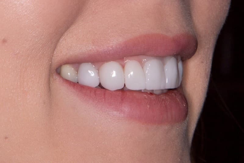 Керамические зубы